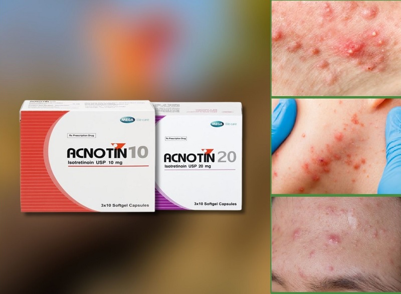 Isotretinoin đẩy mụn