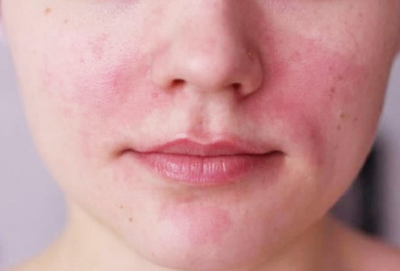 cách nhận biết mụn dị ứng
