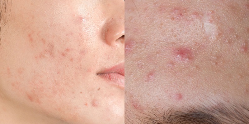 Hình ảnh bị mụn nang