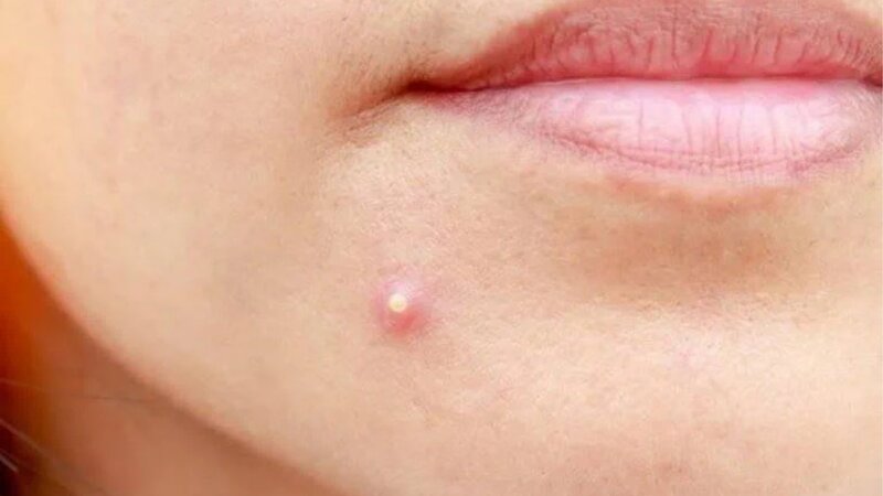 Hình ảnh mụn mủ