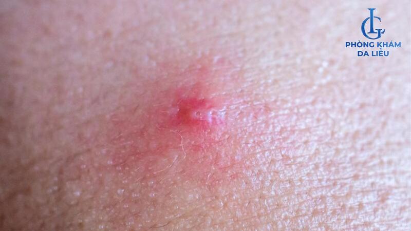 Hình ảnh mụn viêm đỏ không nhân 