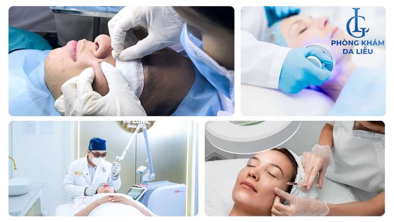 Trị mụn viêm bằng công nghệ cao