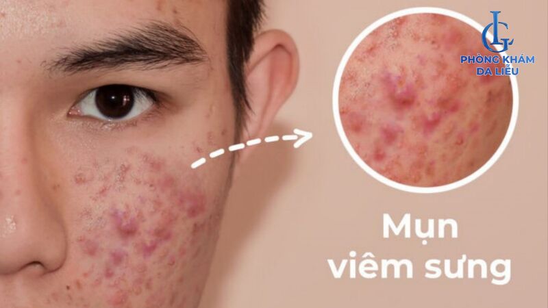 nguyên nhân gây mụn viêm​