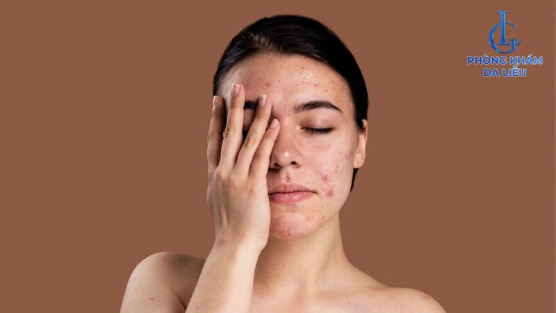 mụn viêm là gì​
