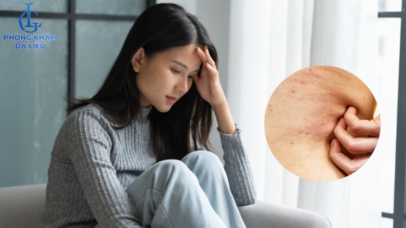 bị mụn lưng khiến người bệnh bị tâm lý