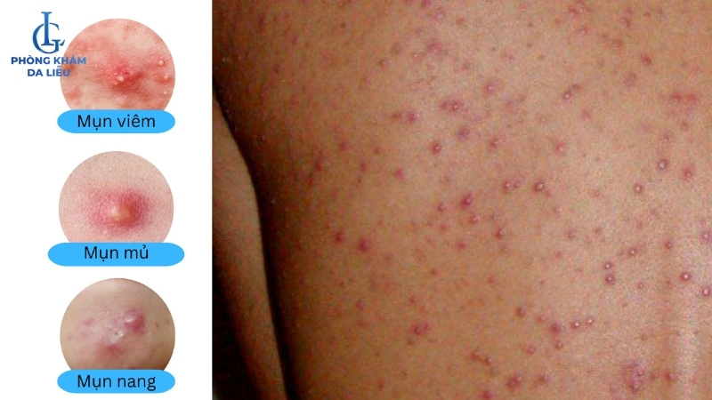 các loại mụn lưng nặng