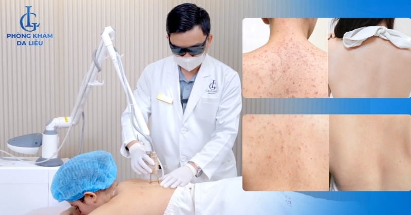 điều trị mụn lưng cần tuân theo hướng dẫn bác sĩ