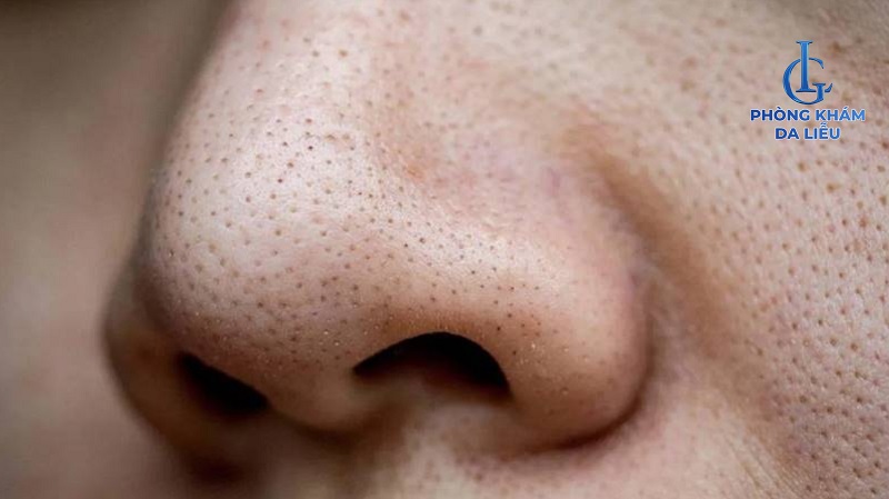 Mụn đầu đen li ti và dày đặc ở mũi