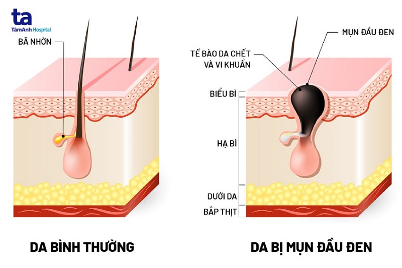phân biệt mụn bình thường và mụn đầu đen