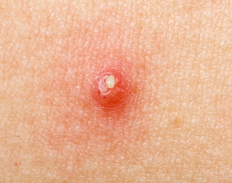 Những cách trị mụn đầu trắng tại nhà