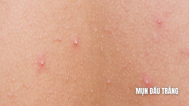 Nguyên nhân chính gây ra mụn đầu trắng