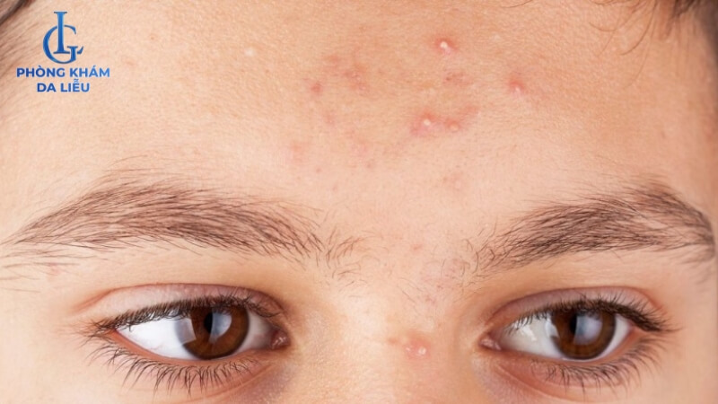 Mụn đầu trắng ở trán