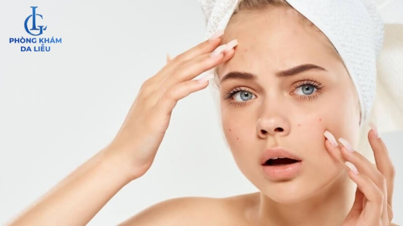 Mụn đầu trắng đầy mặt