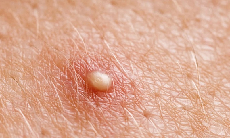 Cách phân biệt mụn đầu trắng