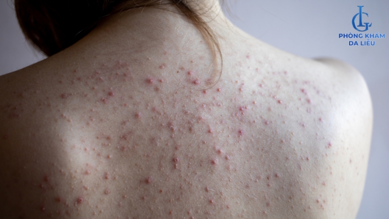 Mụn lưng lan rộng