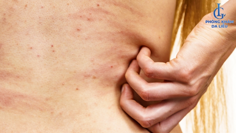 Mụn lưng gây ngứa