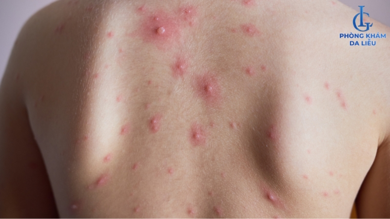 Mụn lưng dai dẳng