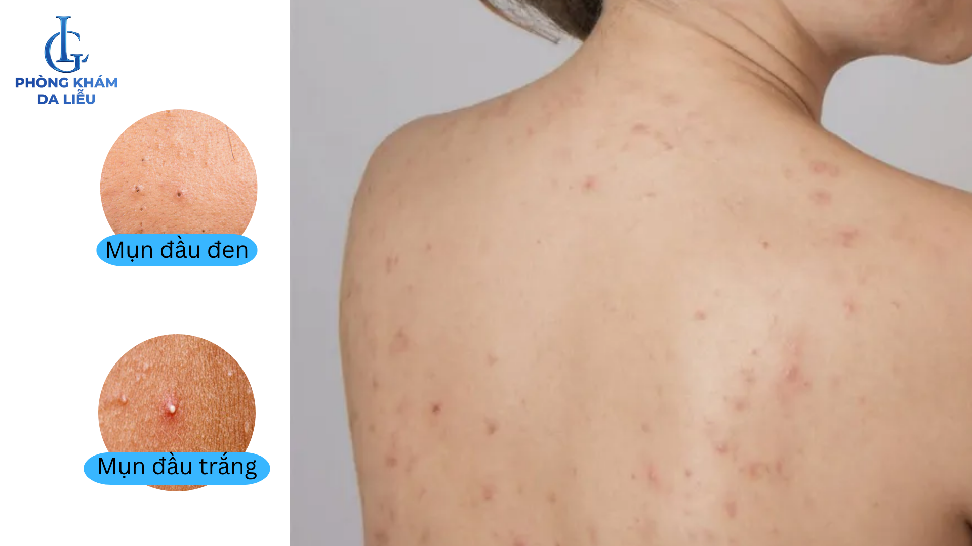 mụn không viêm trên lưng