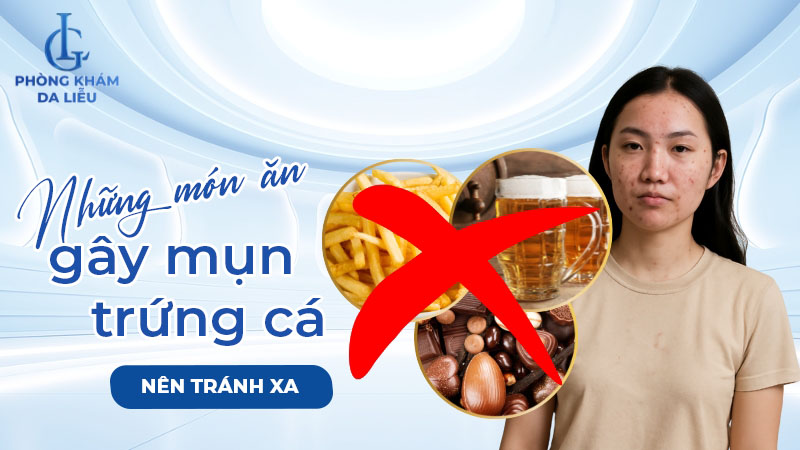 Những món ăn gây mụn trứng cá