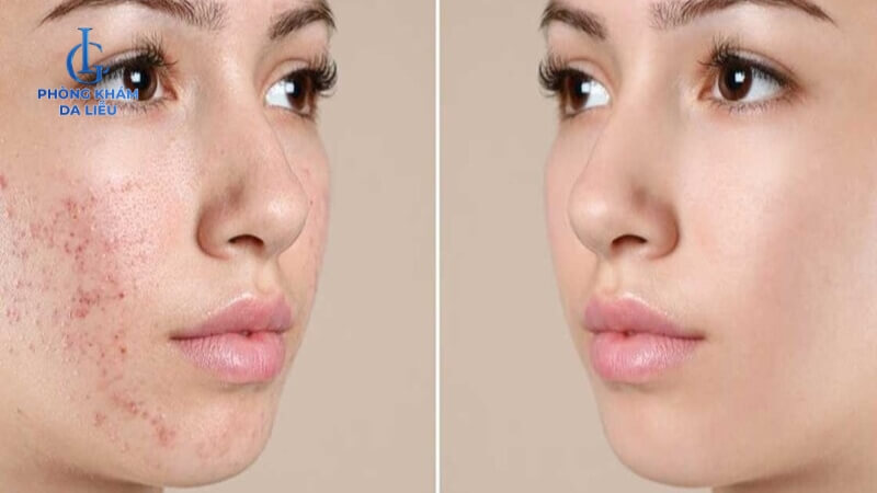 Peel da đẩy mụn trong bao lâu