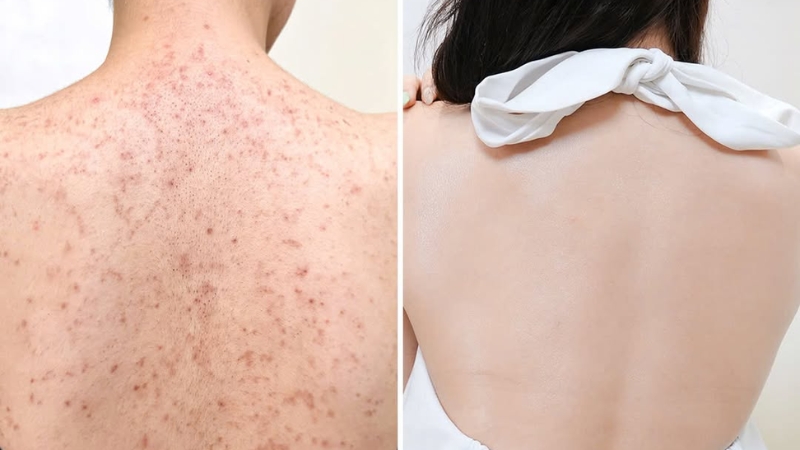 Hiệu quả trị viêm nang lông