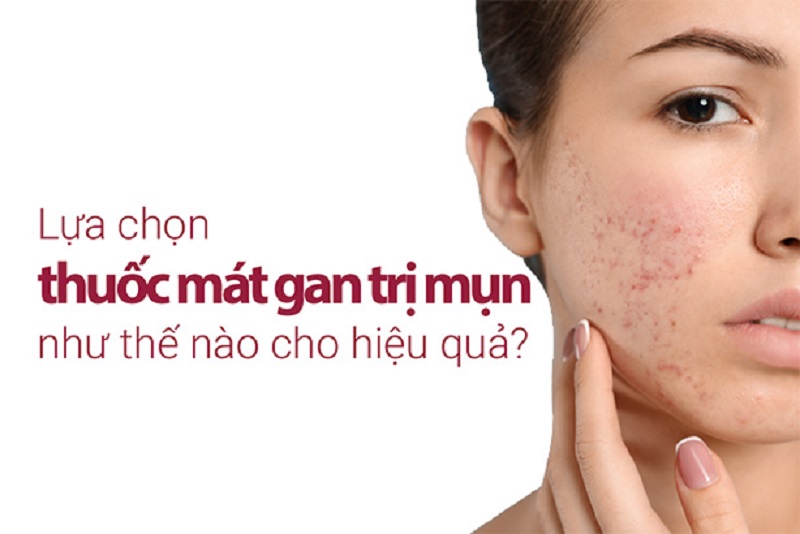 trị mụn bằng thuốc mát gan