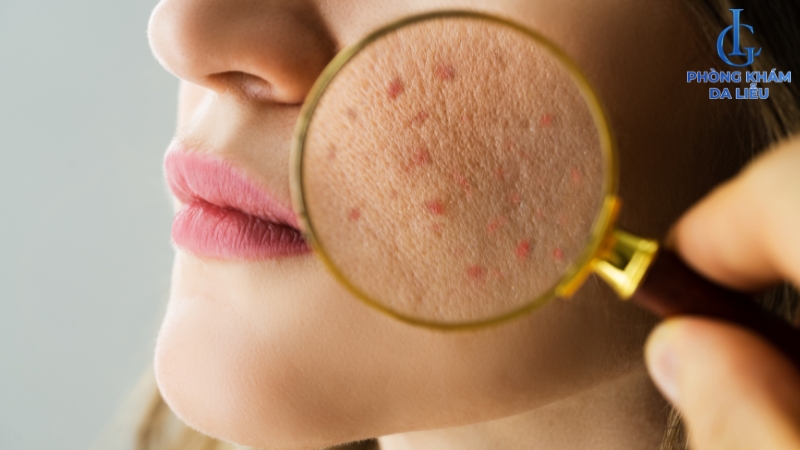 Da nổi mụn khi uống isotretinoin