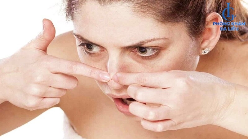 Không nên nặn khi uống isotretinoin