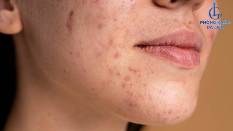 Mụn sẽ bị đẩy trên bề mặt da