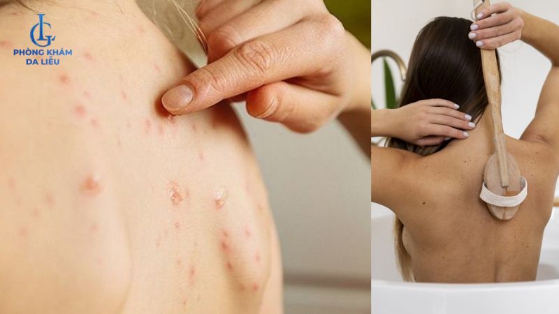 lối sống lành mạnh ngừa mụn lưng