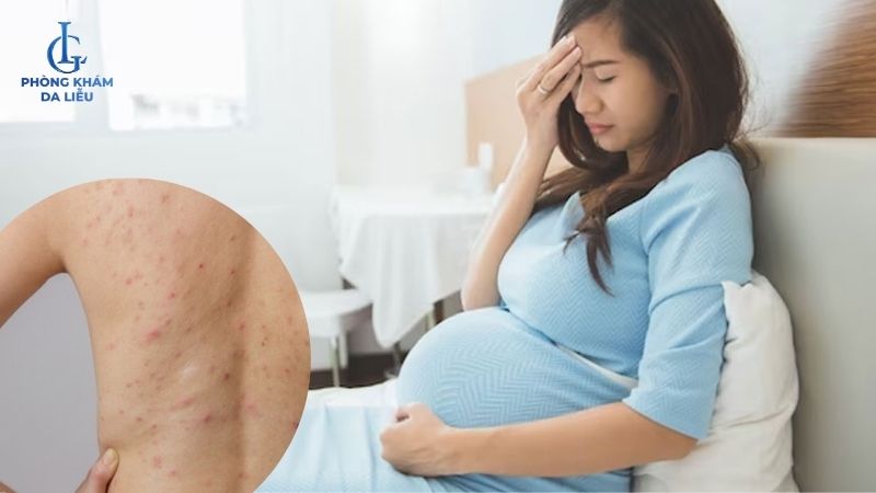 mẹ bầu bị mụn lưng