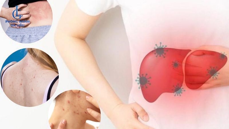 triệu chứng nổi mụn do nóng gan