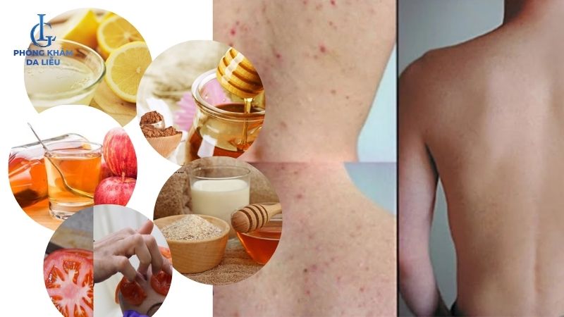 điều trị mụn lưng tại nhà