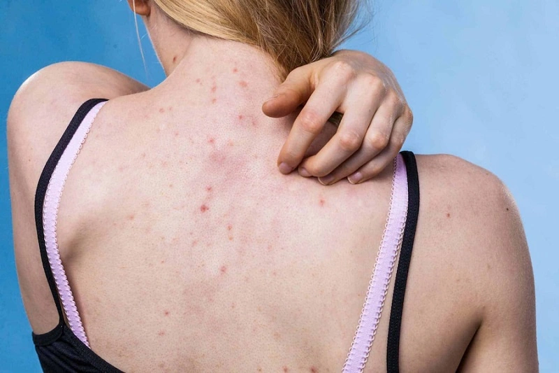bà bầu bị mụn lưng
