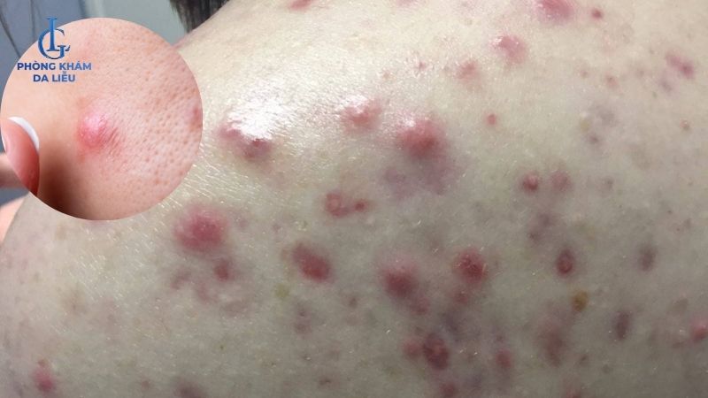mụn nang ở lưng sưng to
