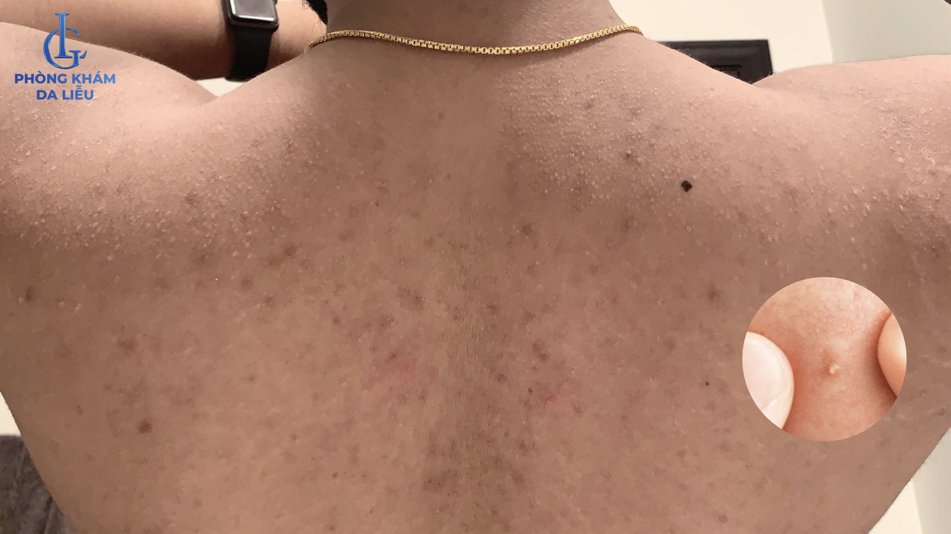 mụn đầu trắng ở lưng nam