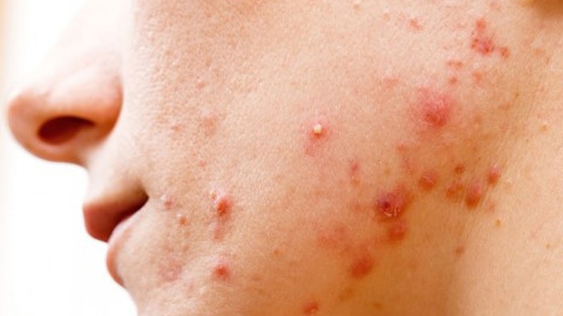 Mụn trứng cá là gì?