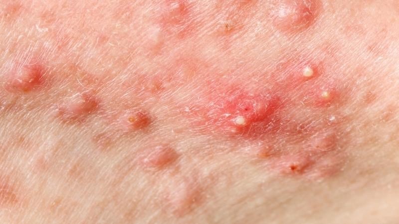 Biến chứng của mụn trứng cá