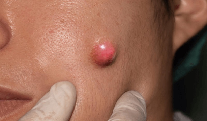 Mụn trứng cá ung