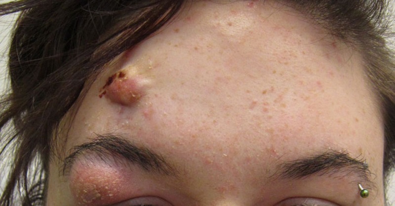 Mụn trứng cá ung có nguy hiểm không?