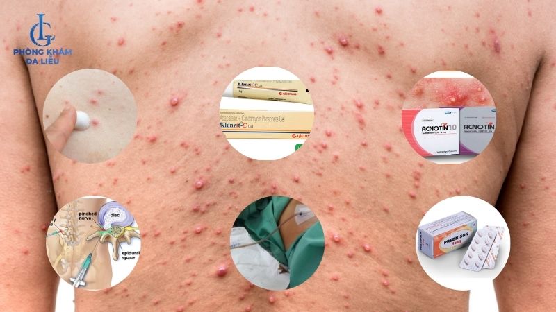 điều trị mụn nang ở lưng