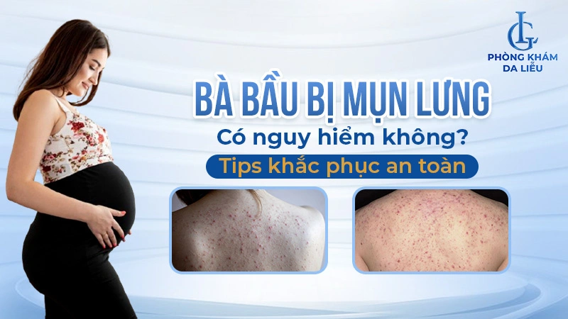 bà bầu bị mụn lưng