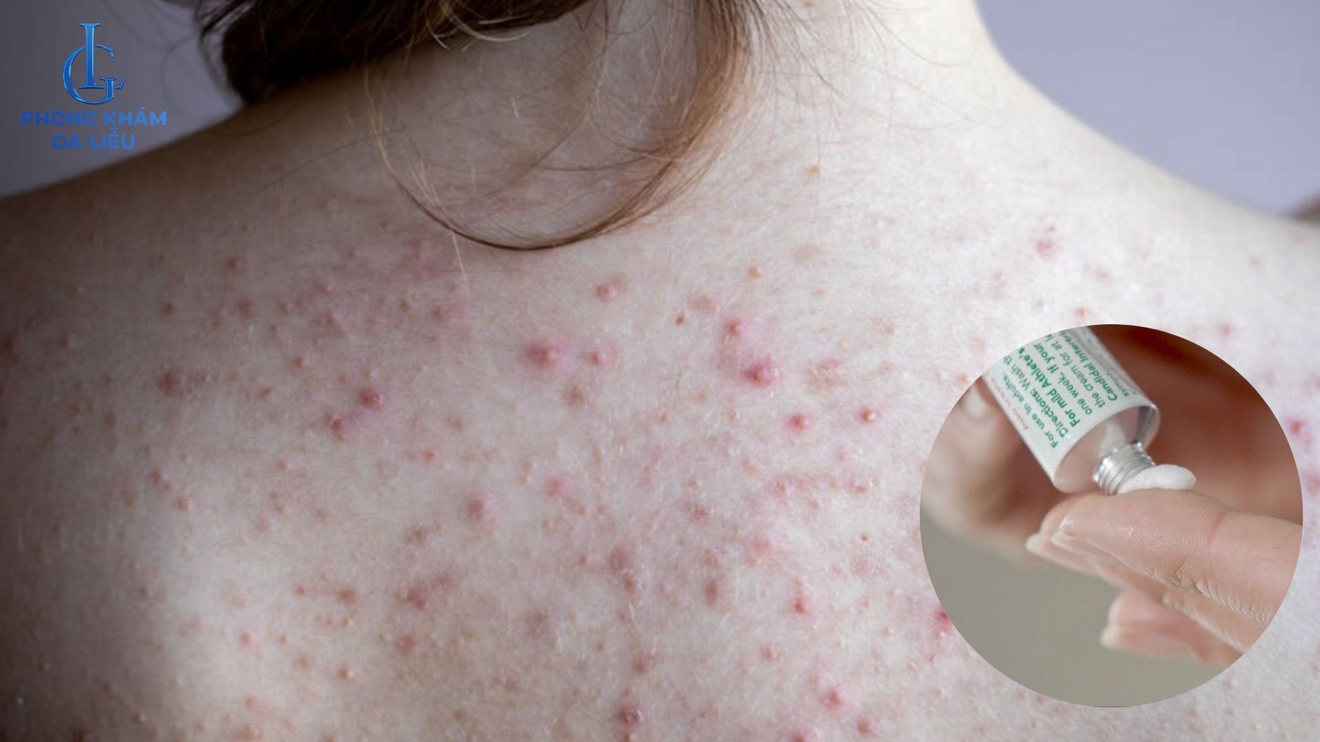 bôi thuốc trị viêm nang lông