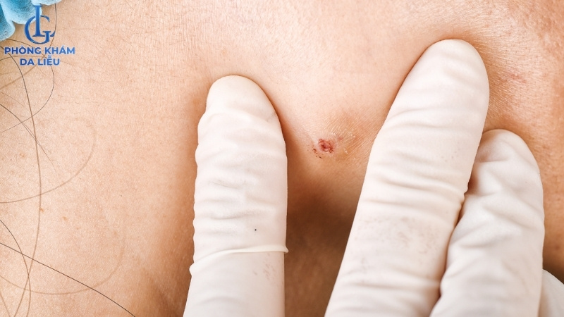 các loại mụn nang ở lưng