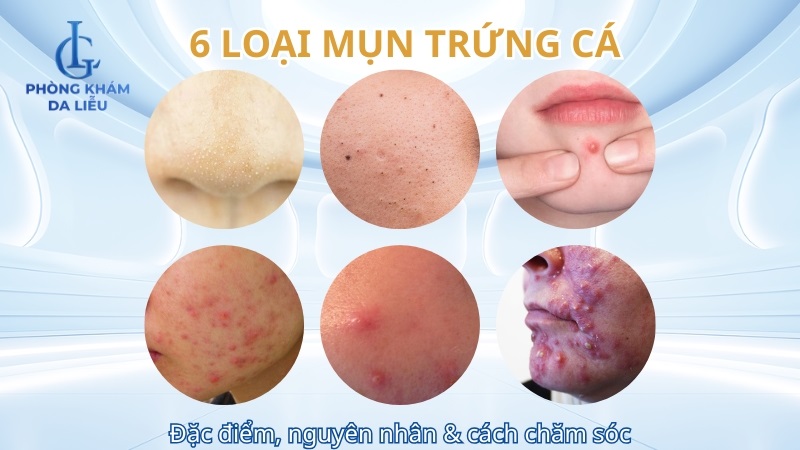 các loại mụn trứng cá