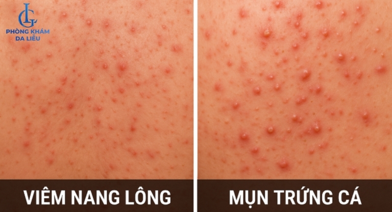 cách phân biệt viêm nang lông lưng và mụn trứng cá