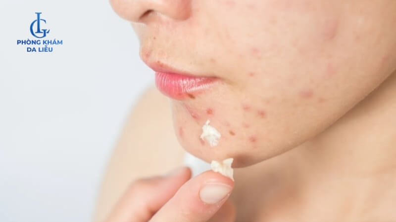 Bôi Benzoyl peroxide và axit salicylic điều trị mụn trứng cá tại nhà