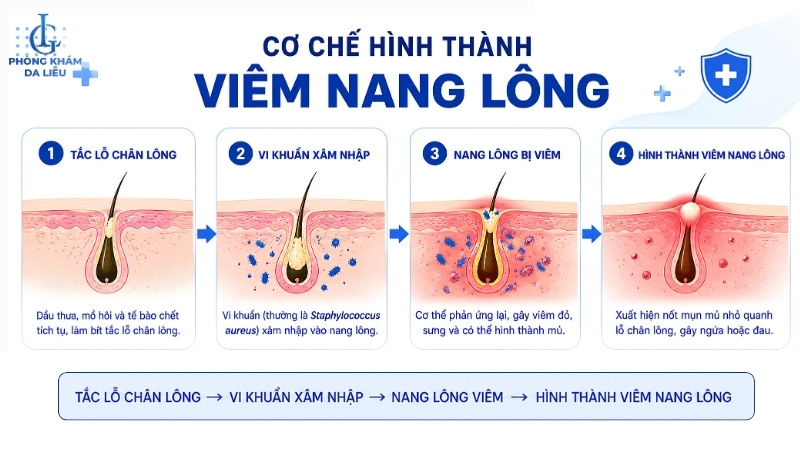 cơ chế hình thành viêm nang lông ở lưng
