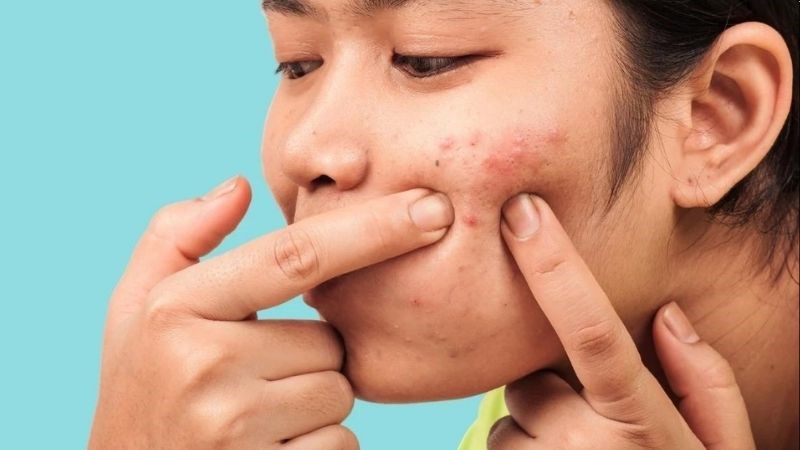 mụn trứng cá có nên nặn không