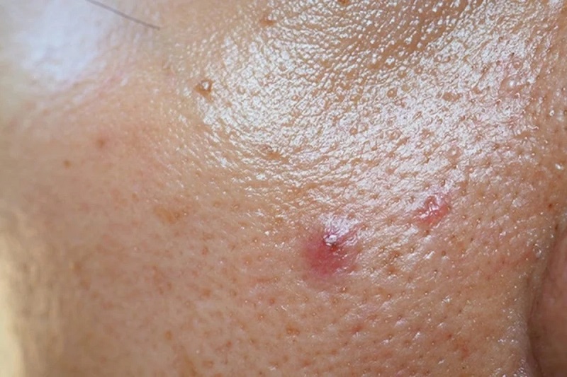 da dầu bị mụn